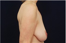 Breast Reduction Before Photo by Michael Law, MD; Raleigh, NC - Case 35600
