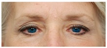 Brow Lift Before Photo by Michael Law, MD; Raleigh, NC - Case 35627