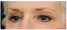 Brow Lift After Photo by Michael Law, MD; Raleigh, NC - Case 35627