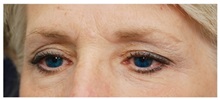 Brow Lift Before Photo by Michael Law, MD; Raleigh, NC - Case 35627