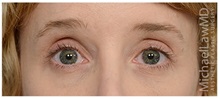 Brow Lift After Photo by Michael Law, MD; Raleigh, NC - Case 35628