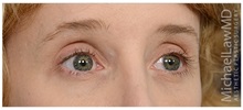 Brow Lift After Photo by Michael Law, MD; Raleigh, NC - Case 35628
