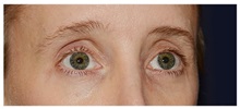 Brow Lift Before Photo by Michael Law, MD; Raleigh, NC - Case 35628