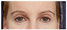 Brow Lift After Photo by Michael Law, MD; Raleigh, NC - Case 35629
