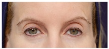 Brow Lift Before Photo by Michael Law, MD; Raleigh, NC - Case 35629