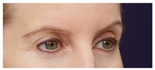 Brow Lift Before Photo by Michael Law, MD; Raleigh, NC - Case 35629