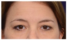 Brow Lift Before Photo by Michael Law, MD; Raleigh, NC - Case 35630