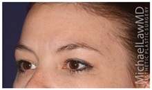Brow Lift After Photo by Michael Law, MD; Raleigh, NC - Case 35630