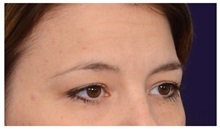 Brow Lift Before Photo by Michael Law, MD; Raleigh, NC - Case 35630