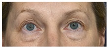 Brow Lift Before Photo by Michael Law, MD; Raleigh, NC - Case 35631