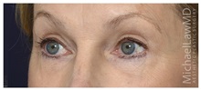 Brow Lift After Photo by Michael Law, MD; Raleigh, NC - Case 35631