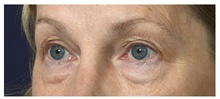 Brow Lift Before Photo by Michael Law, MD; Raleigh, NC - Case 35631
