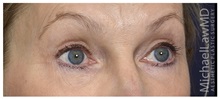 Brow Lift After Photo by Michael Law, MD; Raleigh, NC - Case 35631