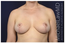 Breast Reduction After Photo by Michael Law, MD; Raleigh, NC - Case 35633