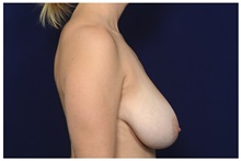 Breast Reduction Before Photo by Michael Law, MD; Raleigh, NC - Case 35633