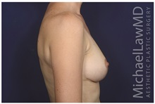 Breast Reduction After Photo by Michael Law, MD; Raleigh, NC - Case 35634