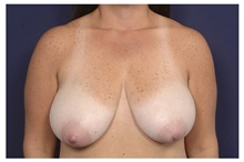 Breast Lift Before Photo by Michael Law, MD; Raleigh, NC - Case 35635