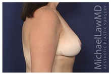 Breast Lift After Photo by Michael Law, MD; Raleigh, NC - Case 35635