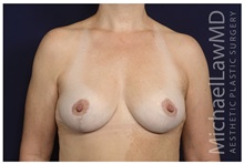 Breast Lift After Photo by Michael Law, MD; Raleigh, NC - Case 35636