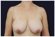 Breast Lift Before Photo by Michael Law, MD; Raleigh, NC - Case 35636