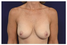 Breast Lift Before Photo by Michael Law, MD; Raleigh, NC - Case 35637