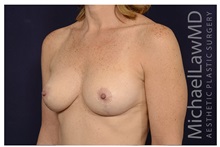 Breast Lift After Photo by Michael Law, MD; Raleigh, NC - Case 35637