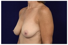 Breast Lift Before Photo by Michael Law, MD; Raleigh, NC - Case 35637