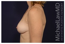 Breast Lift After Photo by Michael Law, MD; Raleigh, NC - Case 35637