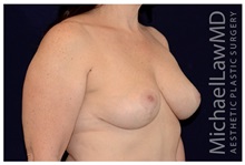 Breast Lift After Photo by Michael Law, MD; Raleigh, NC - Case 35638