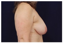 Breast Lift Before Photo by Michael Law, MD; Raleigh, NC - Case 35638
