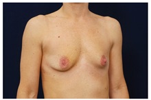 Breast Lift Before Photo by Michael Law, MD; Raleigh, NC - Case 35640