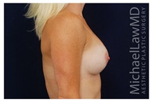 Breast Lift After Photo by Michael Law, MD; Raleigh, NC - Case 35640