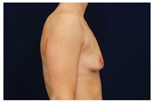 Breast Lift Before Photo by Michael Law, MD; Raleigh, NC - Case 35640