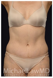 Body Contouring After Photo by Michael Law, MD; Raleigh, NC - Case 35644