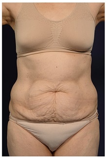 Body Contouring Before Photo by Michael Law, MD; Raleigh, NC - Case 35644