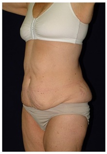 Body Contouring Before Photo by Michael Law, MD; Raleigh, NC - Case 35646