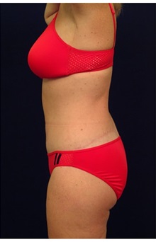 Body Contouring After Photo by Michael Law, MD; Raleigh, NC - Case 35646