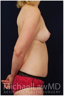 Body Contouring After Photo by Michael Law, MD; Raleigh, NC - Case 35647