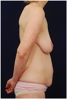 Body Contouring Before Photo by Michael Law, MD; Raleigh, NC - Case 35647