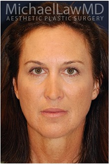 Facelift After Photo by Michael Law, MD; Raleigh, NC - Case 35649