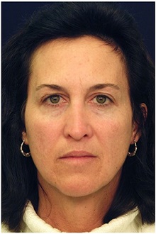 Facelift Before Photo by Michael Law, MD; Raleigh, NC - Case 35649