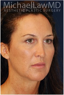 Facelift After Photo by Michael Law, MD; Raleigh, NC - Case 35649