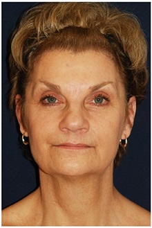 Facelift Before Photo by Michael Law, MD; Raleigh, NC - Case 35653
