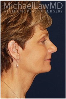 Facelift After Photo by Michael Law, MD; Raleigh, NC - Case 35653