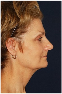 Facelift Before Photo by Michael Law, MD; Raleigh, NC - Case 35653