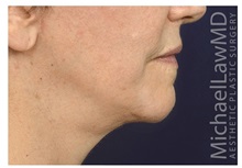 Facelift After Photo by Michael Law, MD; Raleigh, NC - Case 35662