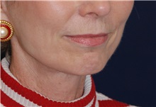 Facelift After Photo by Michael Law, MD; Raleigh, NC - Case 35665