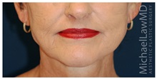Facelift After Photo by Michael Law, MD; Raleigh, NC - Case 35669