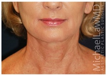 Facelift After Photo by Michael Law, MD; Raleigh, NC - Case 35673