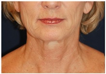 Facelift Before Photo by Michael Law, MD; Raleigh, NC - Case 35673